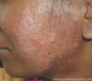 Acne-Scar-Before